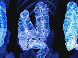 colon cancer symptoms ses causes