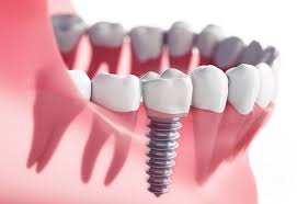 Are Dental Implants For You? Learn More - Sedation Dentist, Dental Implants Monmouth County NJ