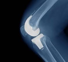 knee replacement lawsuit injury