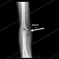 While the medial epicondylar apophysis is if the elbow joint is unstable and/or the fracture is still displaced, we tend to proceed with orif to provide stability for early range of motion and avoid late. Elbow Fractures In Children An Overview Hss Edu