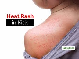 heat rash in kids try these effective