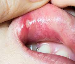 what causes canker sores in your mouth