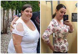 bariatric surgery can help resolve pcos