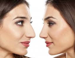 how to decide if rhinoplasty surgery is