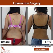 liposuction surgery in bangalore