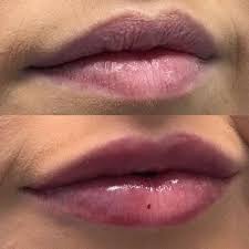 the facts on lip fillers perth coco