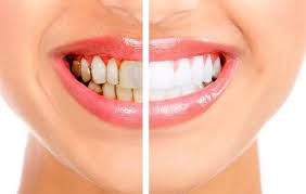 All aspects of kids braces. What Is The Best Way To Whiten Your Teeth Quora