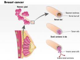 In some cases, breast cancer may not cause any symptoms, but a doctor will identify a mass on a mammogram. 0514 Anatomy Of Thoracic Wall And Breast Presentation Graphics Presentation Powerpoint Example Slide Templates