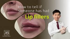 had lip filler injections