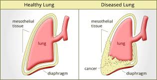 Our resources can help you take steps toward a better quality of life. Types Of Lung Cancer Mesothelioma Ganvwale
