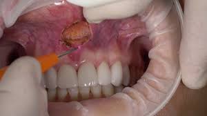 frenectomy procedure with dental laser