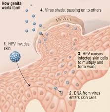 Genital Warts Guide Causes Symptoms And Treatment Options