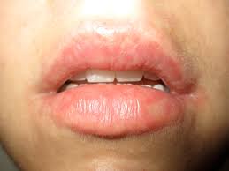 allergic to lip balm causes symptoms