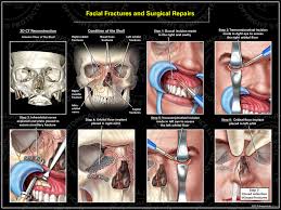fractures and surgical repairs