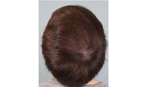 platelet rich plasma prp hair restoration is an advanced treatment physicians have used to help regenerate hair with your own chemistry and cells