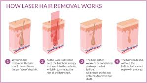 You and your doctor are going to have make a solid argument that is it medically necessary to prevent further recurrences of pilonidal disease. How Laser Hair Removal Works Chiltern Medical Clinics