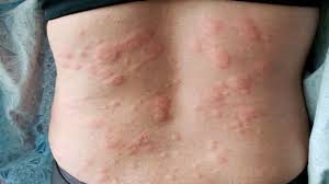 skin rash causes 71 pictures of