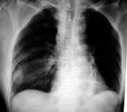 Image result for icd 10 code for right pulmonary nodule