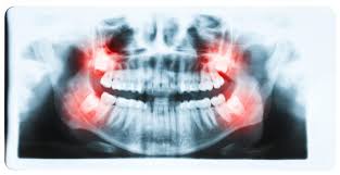 5.5k views reviewed >2 years ago What You Need To Know About Impacted Wisdom Teeth And Braces