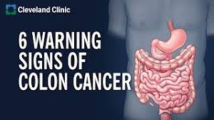 6 warning signs of colon cancer you
