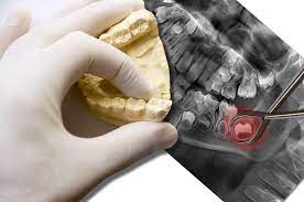 Wisdom teeth are a third set of molars in the back of your mouth. Wisdom Tooth Pain Causes Home Treatment And Prevention