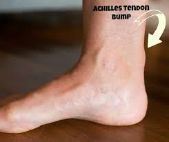 See detailed information below for a list of 3 causes of achilles tendon lump, symptom checker, including diseases and drug side effect causes. Achilles Tendinopathy Symptoms Causes Misconceptions