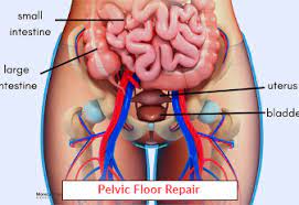 pelvic floor repair pelvic