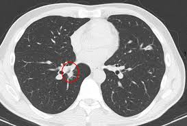 That's because movement could affect the results of the pet scan. How To Interpret Ct Scans Of Your Lung