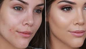 hiding your acne with makeup
