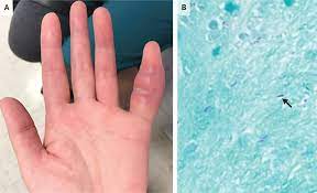 Terabit (tb), a unit of information (often measuring data transfer). Tuberculosis Of The Finger Woman Suffers Rare Symptom Of Infection