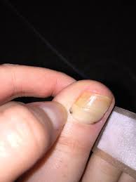Maybe you would like to learn more about one of these? What Is Going On With My Toe Black Spots By Cuticle Yellow Nail Nailfungus