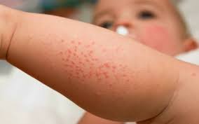 14 newborn rashes you need to know