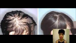 natural hair loss treatment check