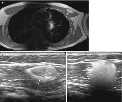 adipocytic tumors radiology key