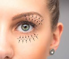 blepharoplasty surgery costs recovery