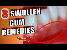 swollen gums