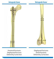 the gap nail endo exo medullary system