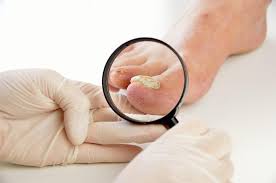 toenail fungus go untreated