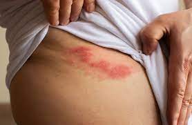 Shingles: Signs, symptoms and treatment | CNN