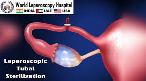 laparoscopic tubal sterilization