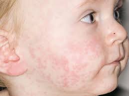 roseola vs measles rash what is the
