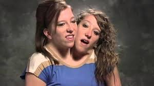 The twins were born in carver county, minnesota, but that wasn't the amazing thing about their birth. Abby And Brittany Hensel See What The Famous Conjoined Twins Look Like Today