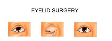 types of eyelid surgery