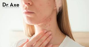 cystic acne treatment symptoms and
