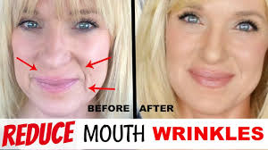 mouth wrinkles without fillers
