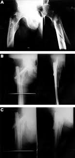 proximal fem fractures