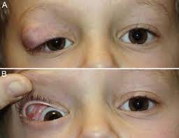 developmental conjunctival cyst of the