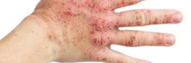 hand eczema dermais the