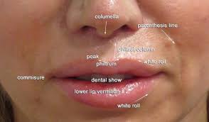 upper lip shortening and lip