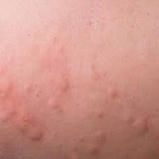 As the manifestations of dengue and chikungunya are almost. Skin Rash Causes 68 Pictures Of Symptoms And Treatments